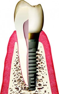 Malcomson Dentistry Implant