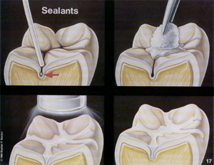 Malcomson Dentistry Sealant