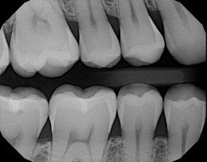Xray