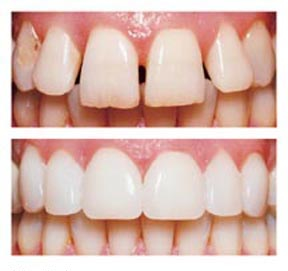 Malcomson Dentistry veneers