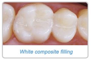 composite-filling