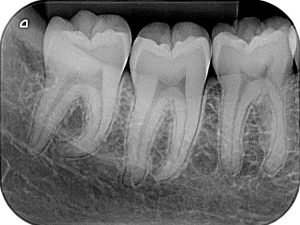 periapical